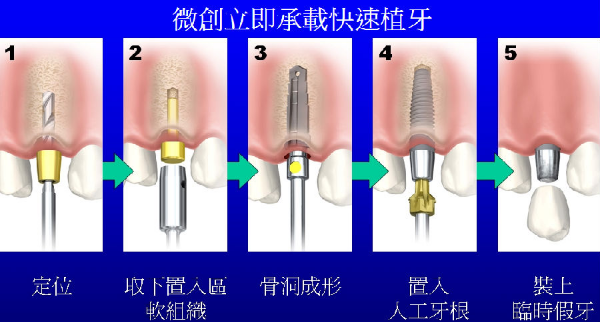 微創植牙 快速植牙節省時間台中植牙推薦20年牙醫 微創無痛舒眠植牙 喨粒晶台中植牙中心
